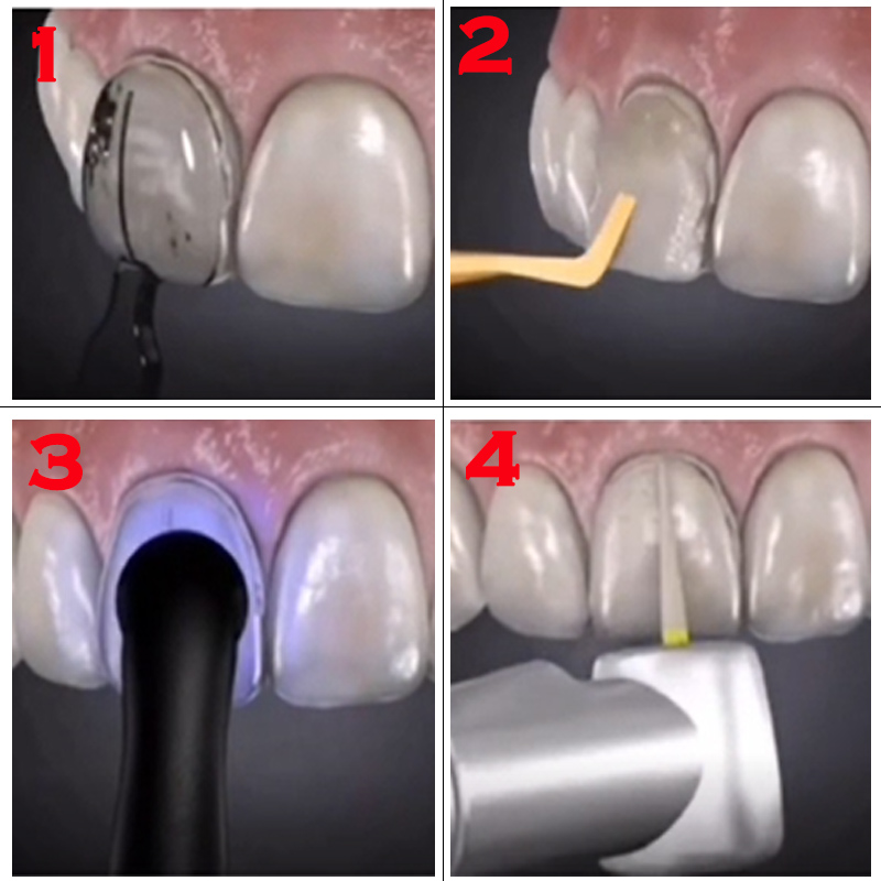 32個入り歯のホワイトニングモールド デンタルラボキット コ - Teeth Whitening Moulds のレビューと価格