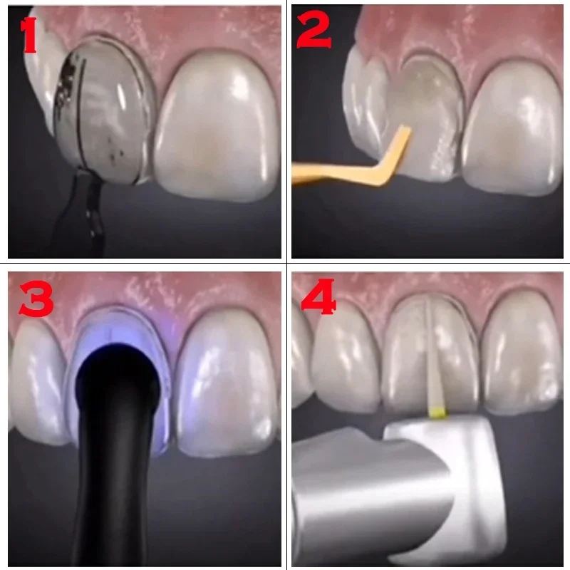 歯科用コンポジットレジンベニア用歯型、光硬化充填用、前歯用、 - Teeth Whitening Moulds のレビューと価格